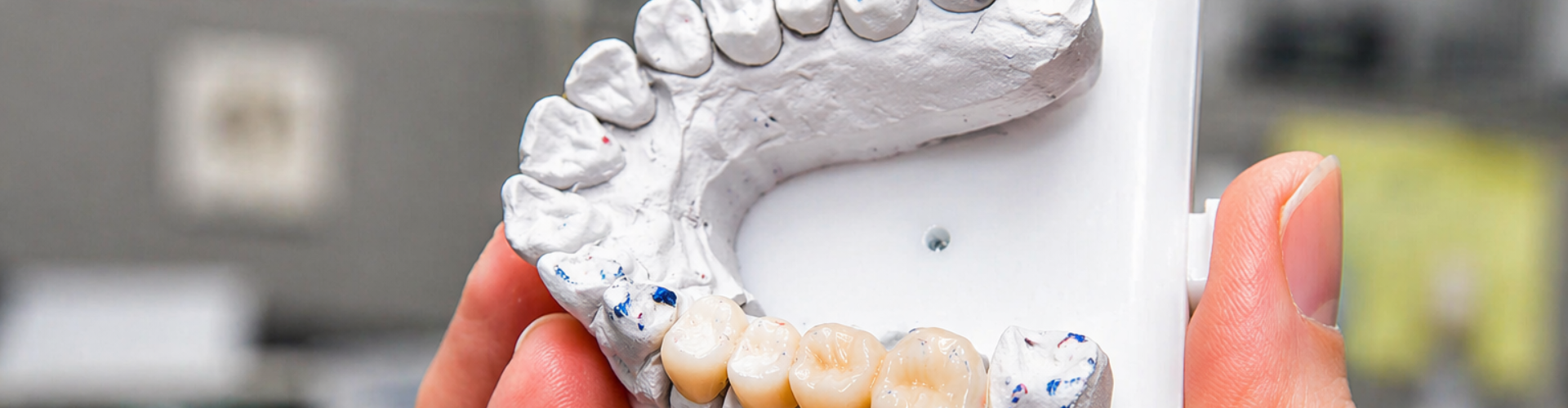 Hand holding plaster mold with dental bridge on teeth.